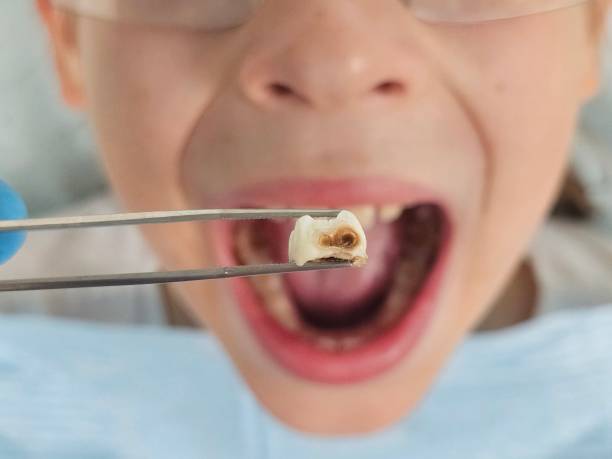 Best Holiday Emergency Dentist in Sonoma State University, CA